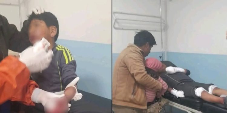 Niño de 9 años pierde cinco dedos por explosión de petardo en bloqueos de El Alto